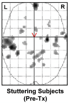 FMRI - Stuttering Subjects Pre-Tx