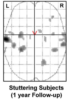 FMRI - Stuttering Subjects 1 year follow-up